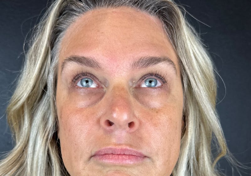 Wrinkle Relaxer Before & After Gallery - Patient 241527 - Image 2