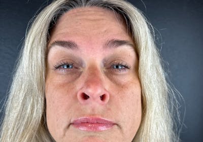 Wrinkle Relaxer Before & After Gallery - Patient 241527 - Image 1