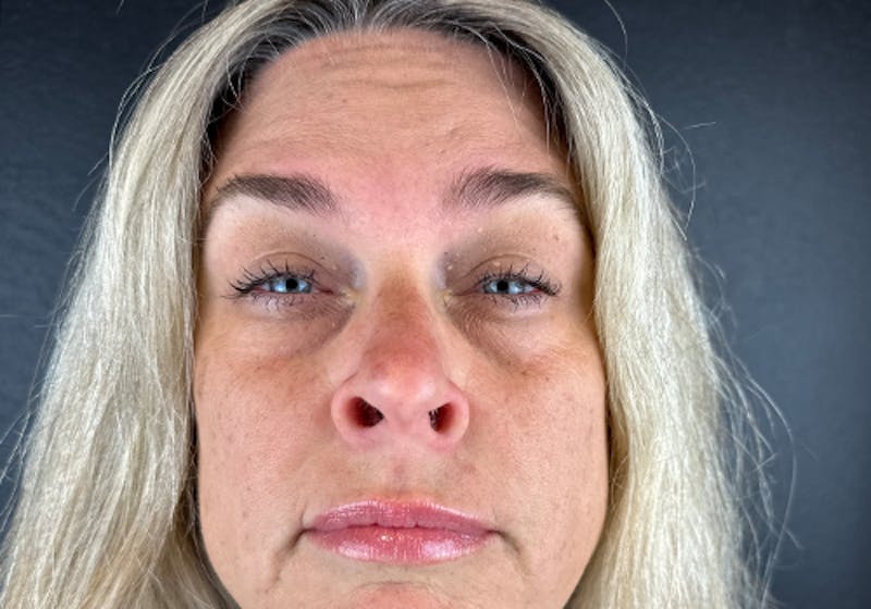Wrinkle Relaxer Before & After Gallery - Patient 241527 - Image 1