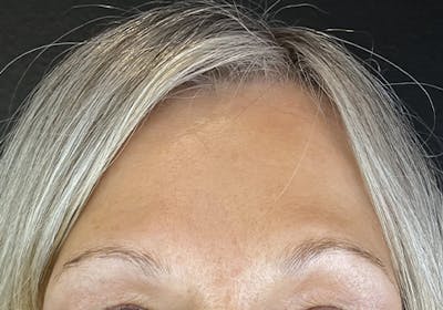 Wrinkle Relaxer Before & After Gallery - Patient 613392 - Image 2