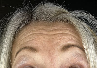 Wrinkle Relaxer Before & After Gallery - Patient 613392 - Image 1