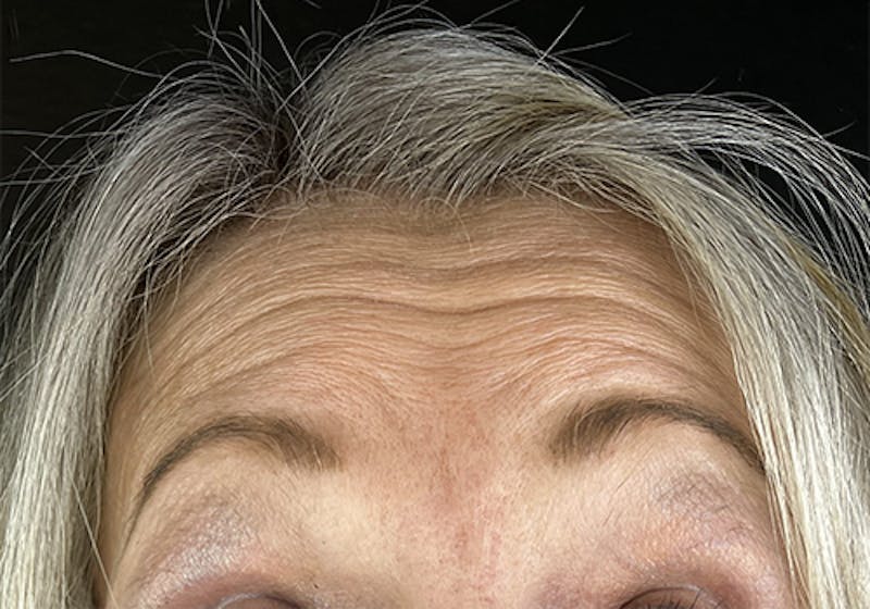 Wrinkle Relaxer Before & After Gallery - Patient 613392 - Image 1