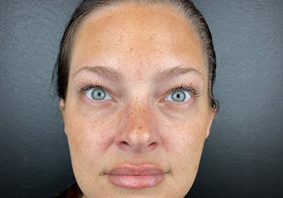 Wrinkle Relaxer Before & After Gallery - Patient 100019 - Image 2