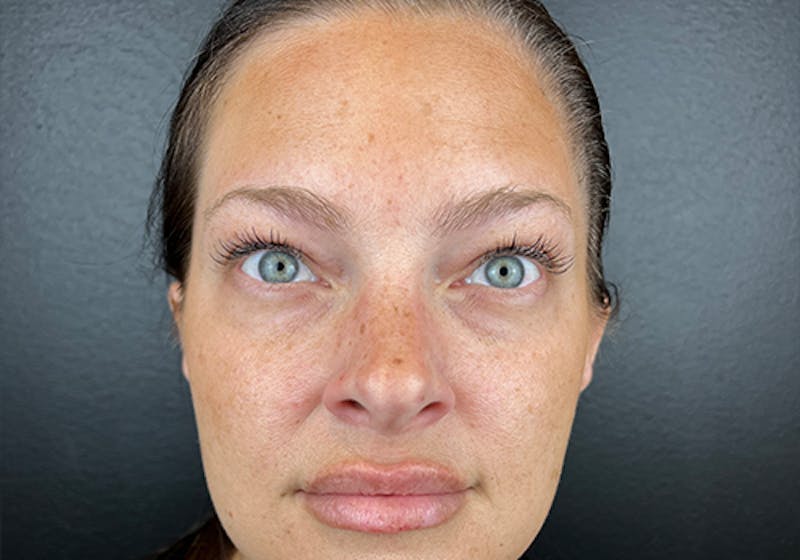 Wrinkle Relaxer Before & After Gallery - Patient 100019 - Image 2