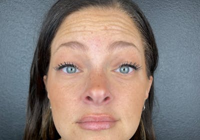 Wrinkle Relaxer Before & After Gallery - Patient 100019 - Image 1
