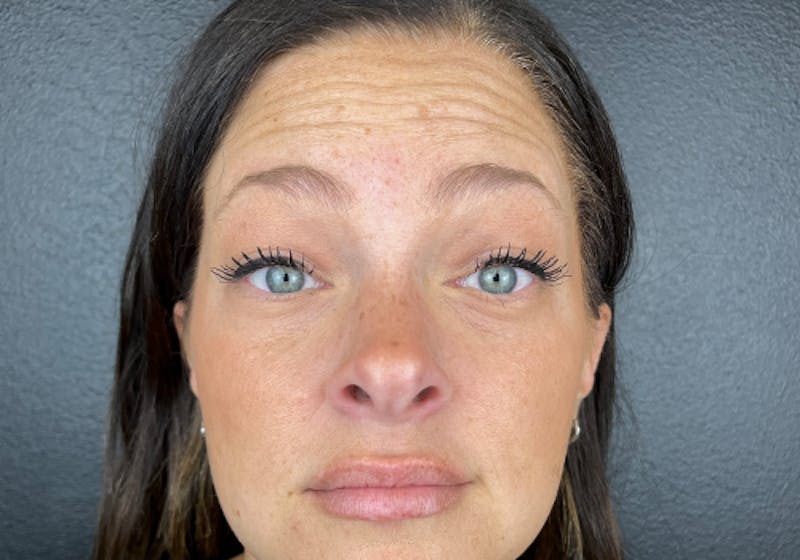 Wrinkle Relaxer Before & After Gallery - Patient 100019 - Image 1