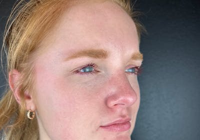 Wrinkle Relaxer Before & After Gallery - Patient 418460 - Image 2