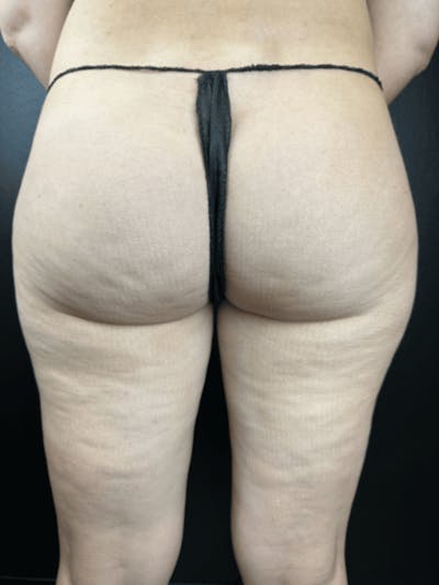 Body Contouring Before & After Gallery - Patient 219811 - Image 1
