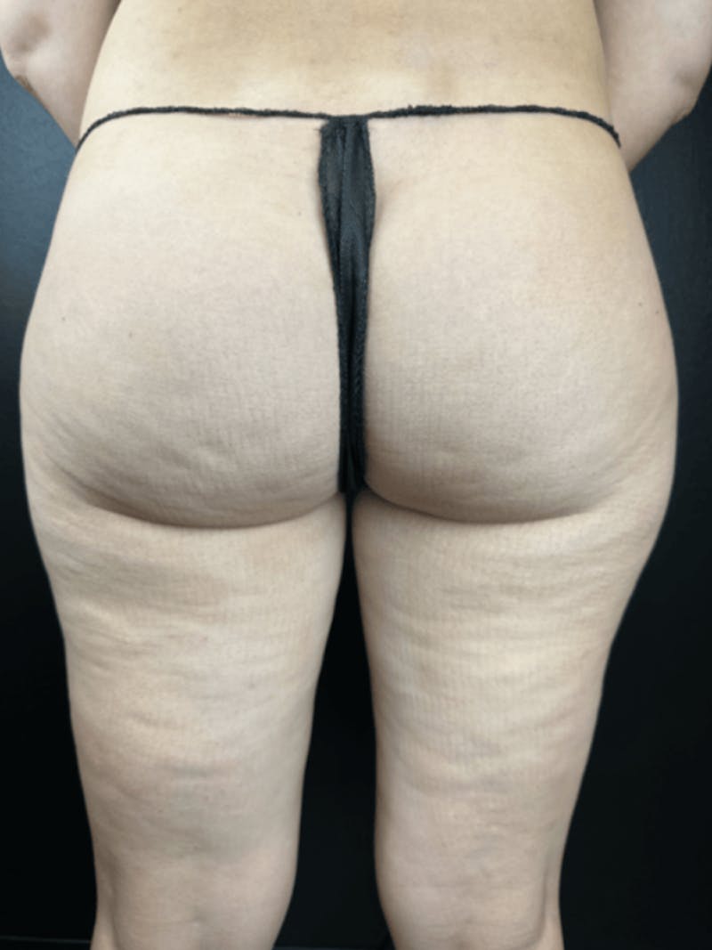 Body Contouring Before & After Gallery - Patient 219811 - Image 1