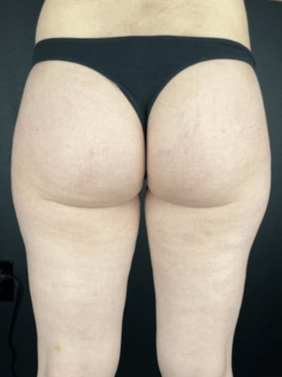Body Contouring Before & After Gallery - Patient 219811 - Image 2