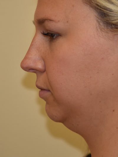 Chin Implant Before & After Gallery - Patient 252351 - Image 1
