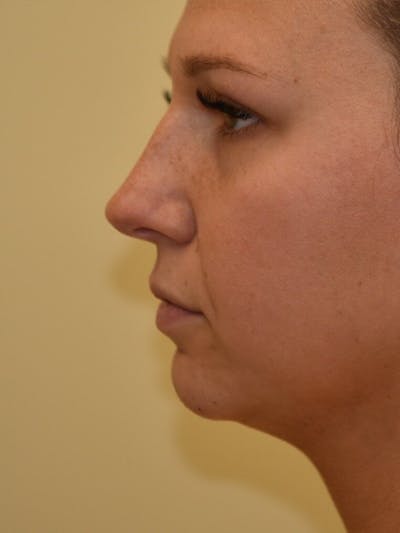 Chin Implant Before & After Gallery - Patient 252351 - Image 2