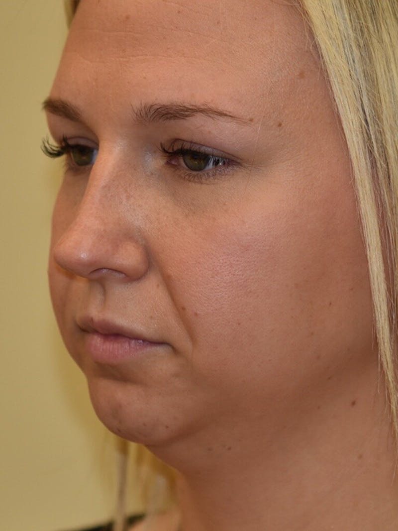 Chin Implant Before & After Gallery - Patient 252351 - Image 3
