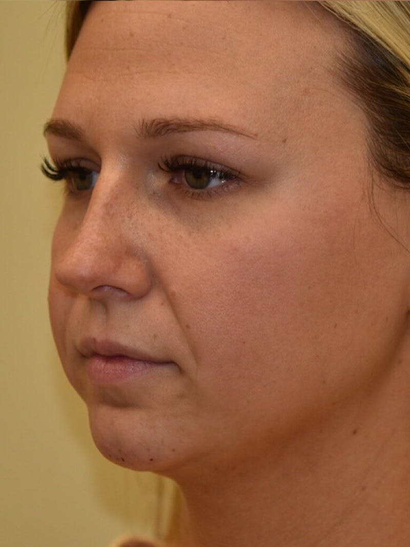 Chin Implant Before & After Gallery - Patient 252351 - Image 4