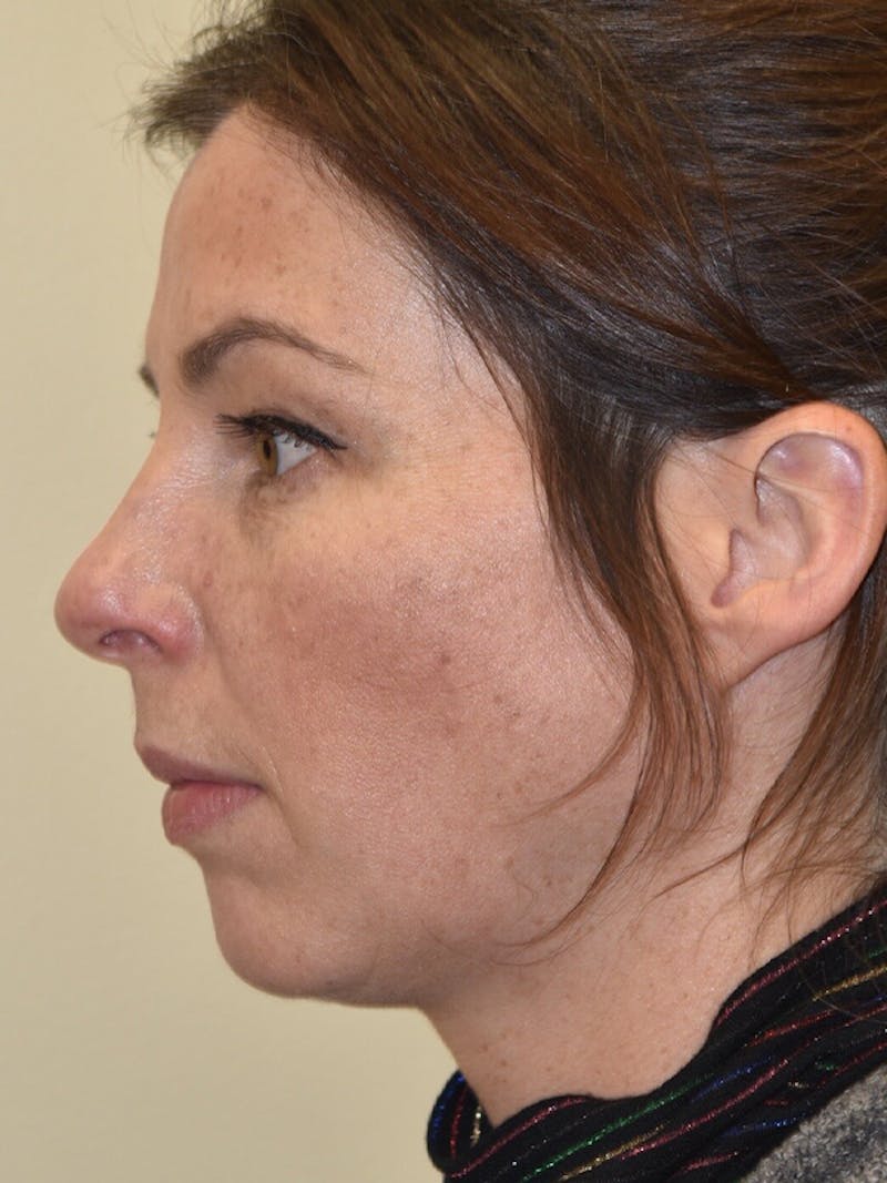 Chin Implant Before & After Gallery - Patient 187362 - Image 3