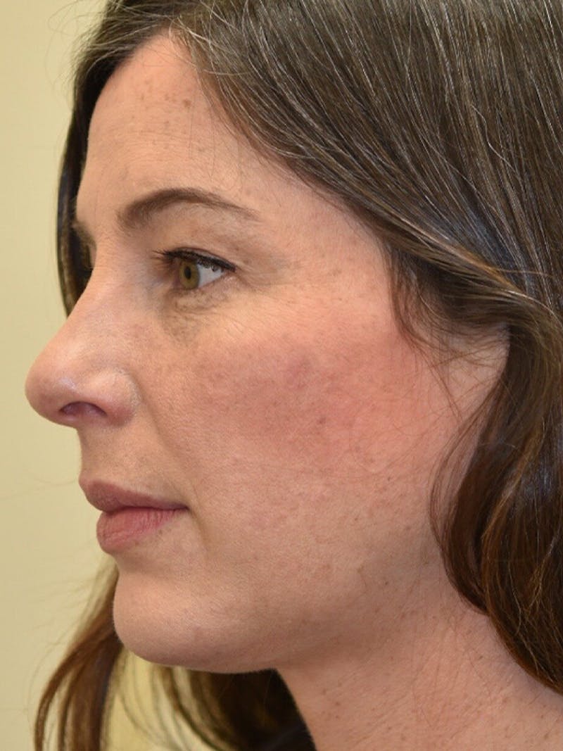 Chin Implant Before & After Gallery - Patient 187362 - Image 4