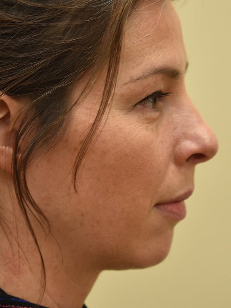 Chin Implant Before & After Gallery - Patient 187362 - Image 5