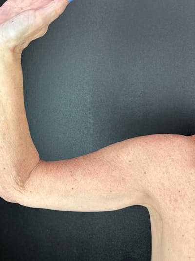 Arm Lift Before & After Gallery - Patient 174459 - Image 2