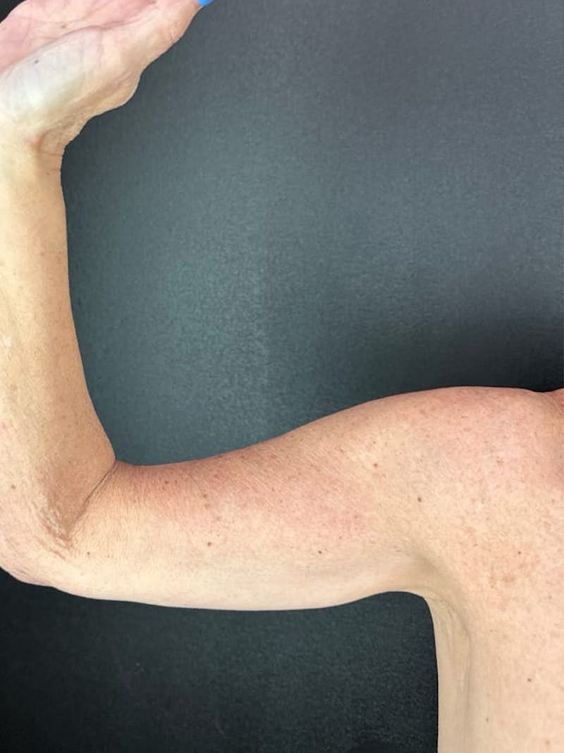 Arm Lift Before & After Gallery - Patient 174459 - Image 2