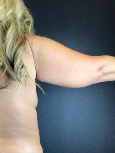 Arm Lift Before & After Gallery - Patient 180666 - Image 1