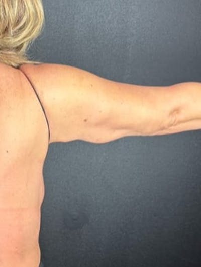 Arm Lift Before & After Gallery - Patient 180666 - Image 2
