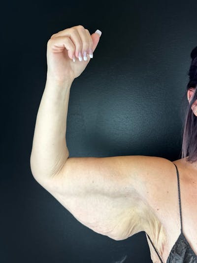 Arm Lift Before & After Gallery - Patient 568338 - Image 1