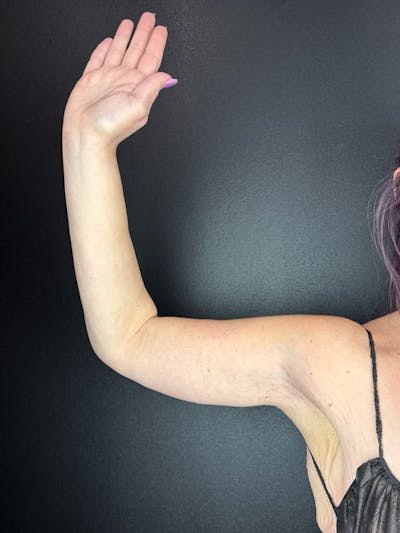 Arm Lift Before & After Gallery - Patient 568338 - Image 2