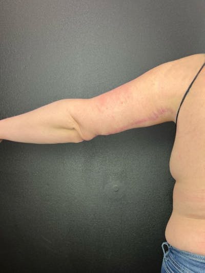 Arm Lift Before & After Gallery - Patient 162627 - Image 2