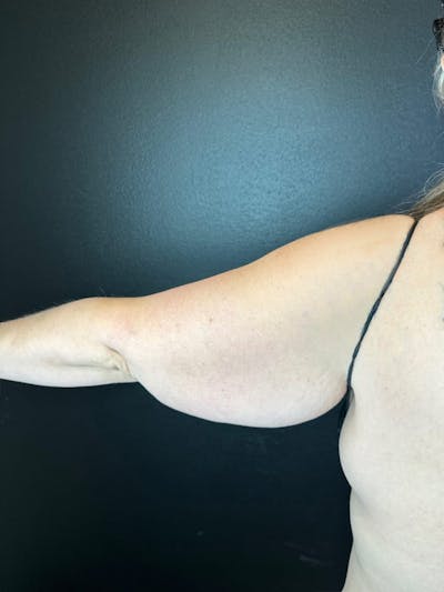 Arm Lift Before & After Gallery - Patient 162627 - Image 1