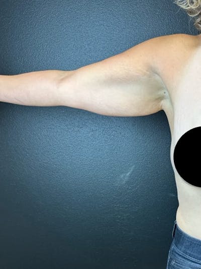 Arm Lift Before & After Gallery - Patient 391626 - Image 1