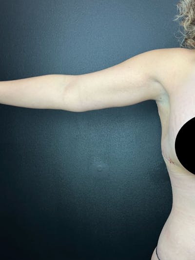 Arm Lift Before & After Gallery - Patient 391626 - Image 2