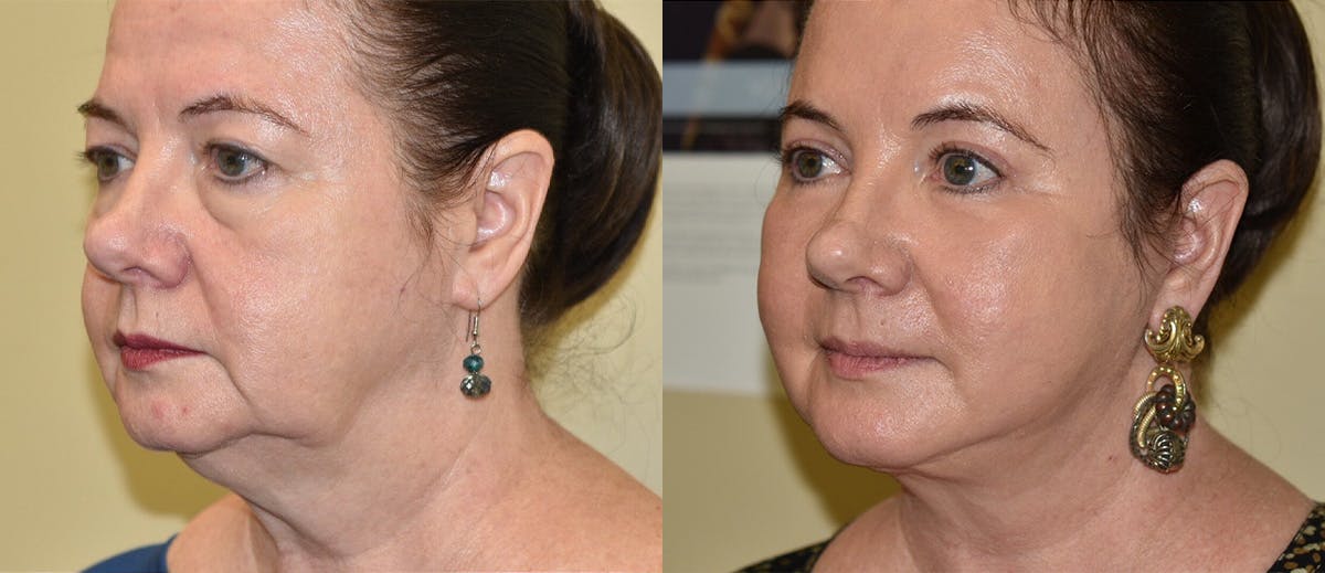 Neck Lift Before & After Gallery - Patient 207892 - Image 1