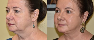 Neck Lift Before & After Gallery - Patient 207892 - Image 1