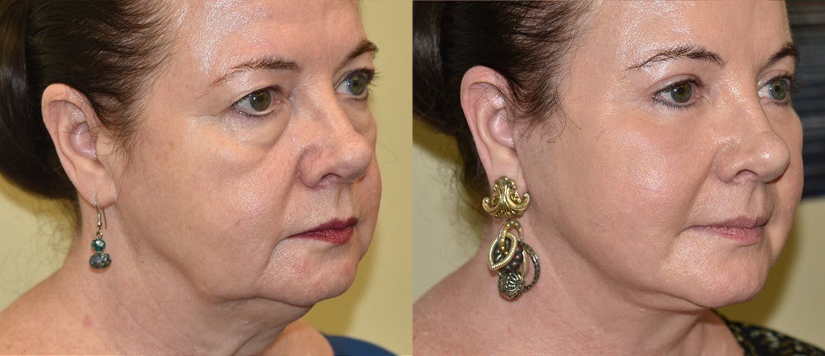 Neck Lift Before & After Gallery - Patient 207892 - Image 3