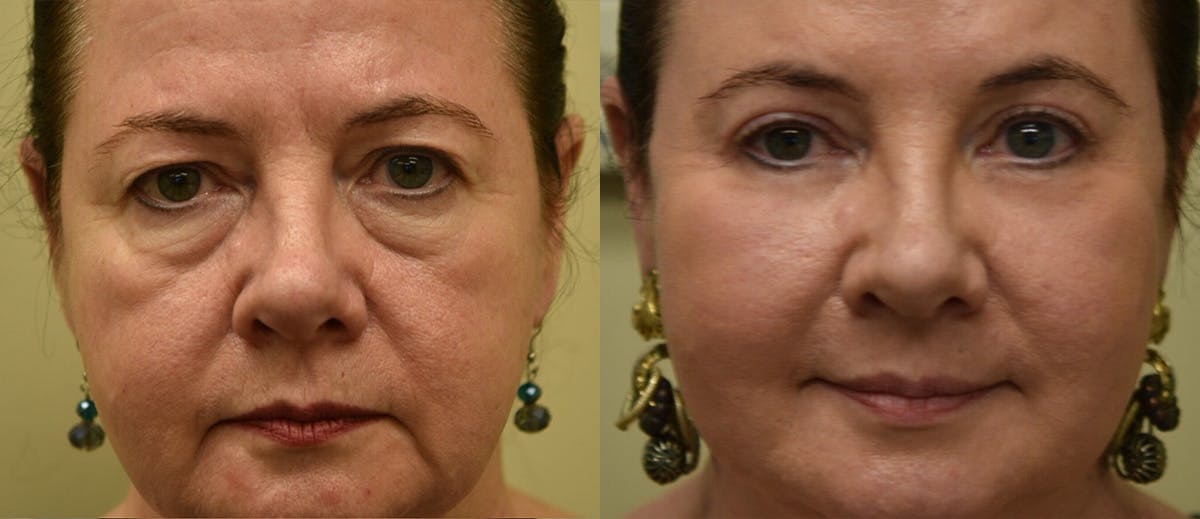 Neck Lift Before & After Gallery - Patient 207892 - Image 2