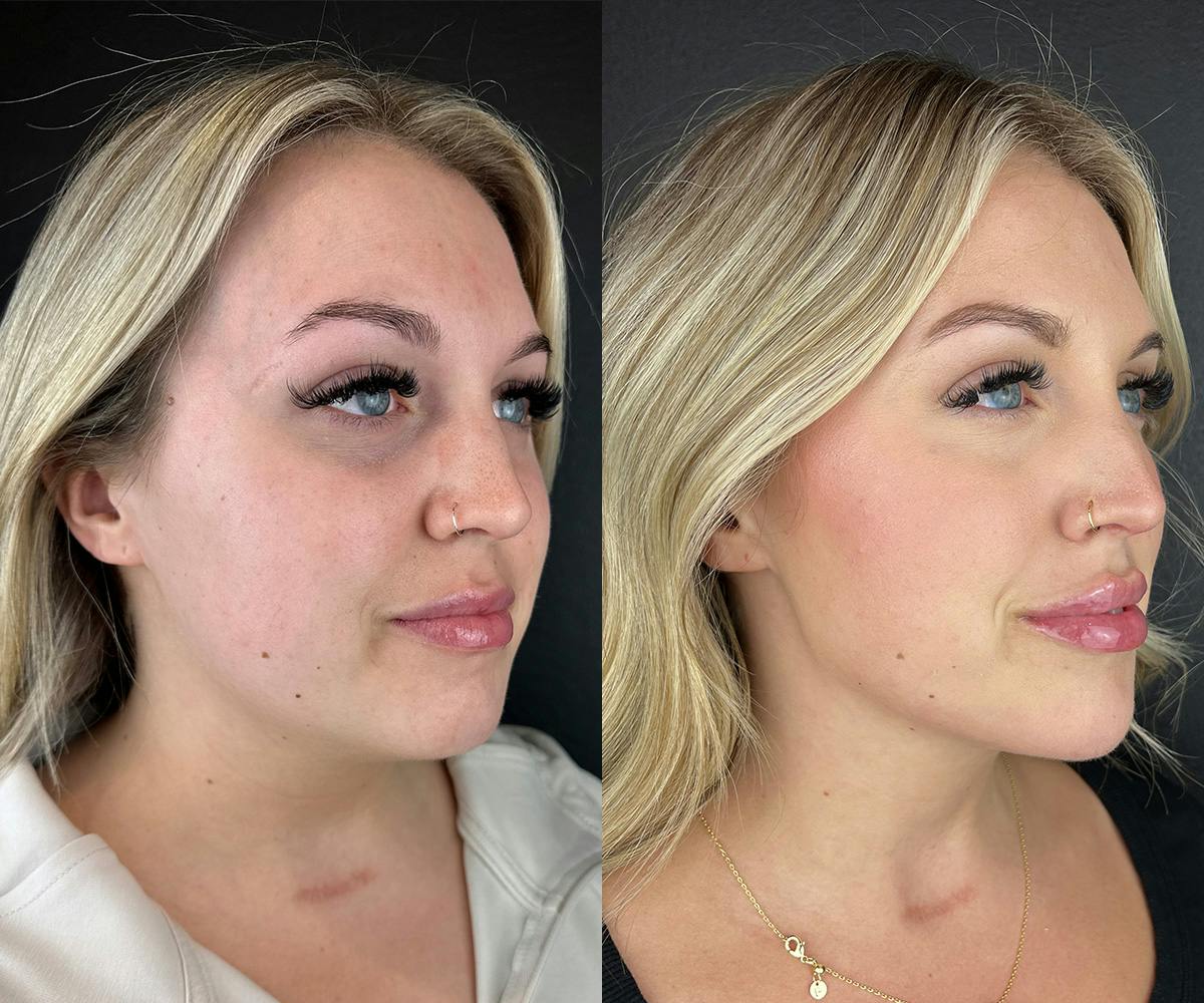 Chin Filler Before & After Gallery - Patient 397345 - Image 1