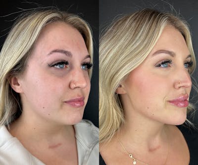Chin Filler Before & After Gallery - Patient 397345 - Image 1
