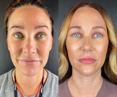 Chin Filler Before & After Gallery - Patient 403572 - Image 1