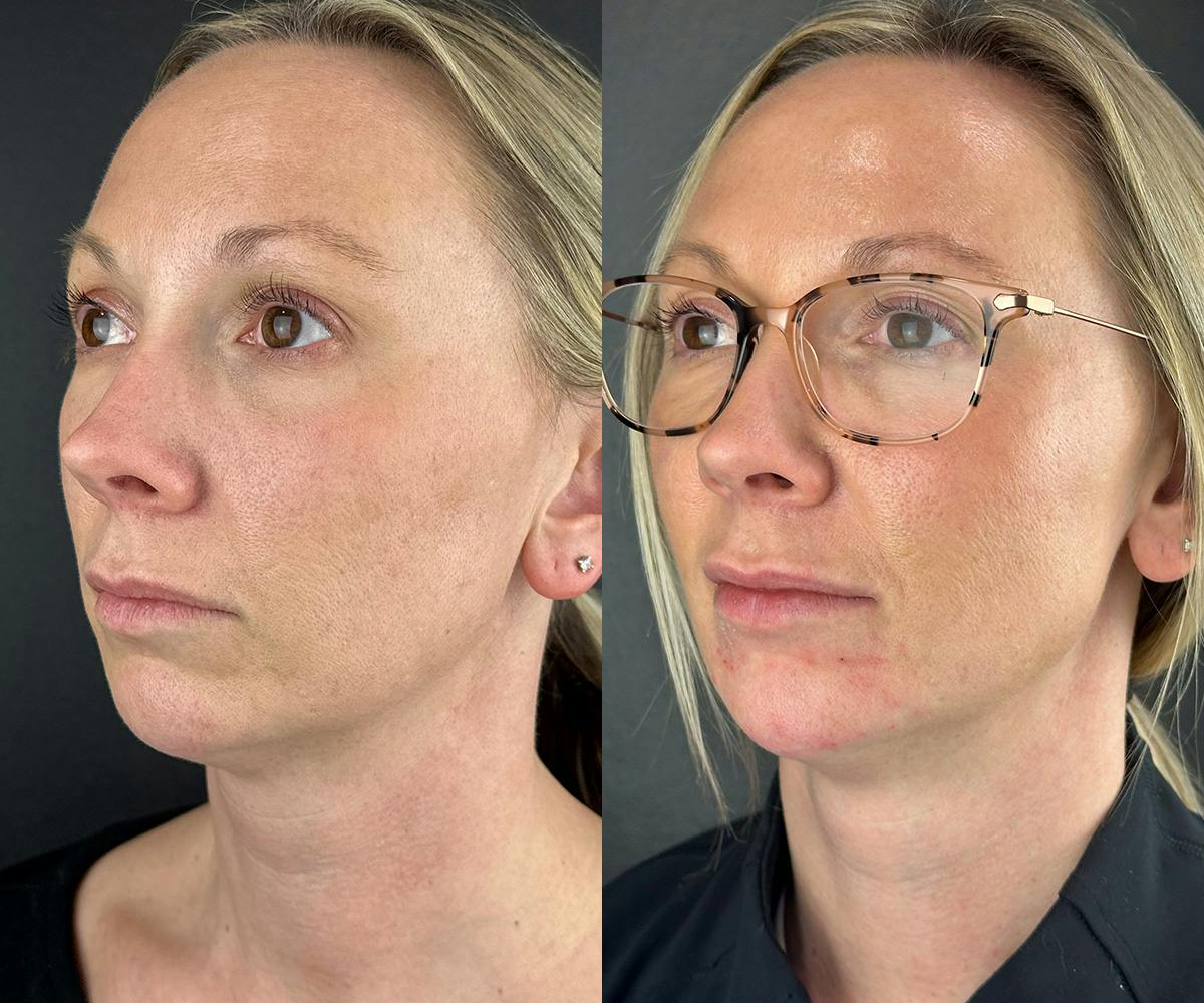 Chin Filler Before & After Gallery - Patient 632529 - Image 1