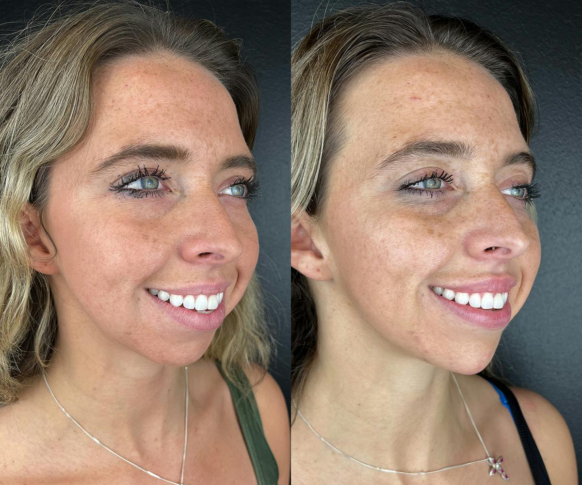 Chin Filler Before & After Gallery - Patient 209240 - Image 3