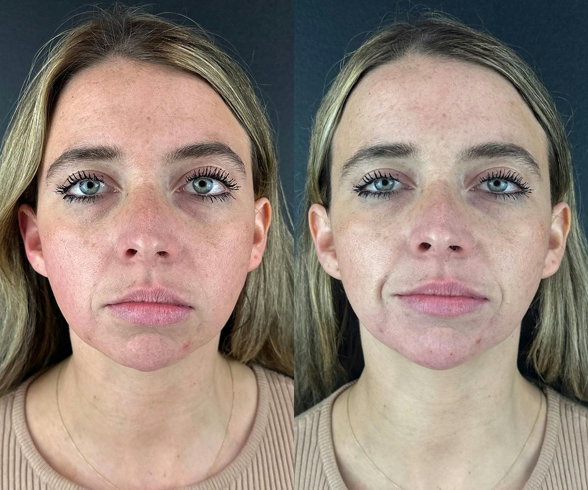 Chin Filler Before & After Gallery - Patient 209240 - Image 1