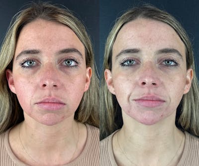 Chin Filler Before & After Gallery - Patient 209240 - Image 1