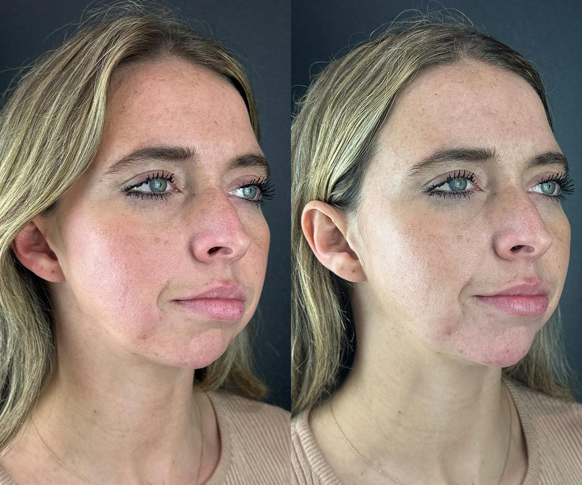 Chin Filler Before & After Gallery - Patient 209240 - Image 4