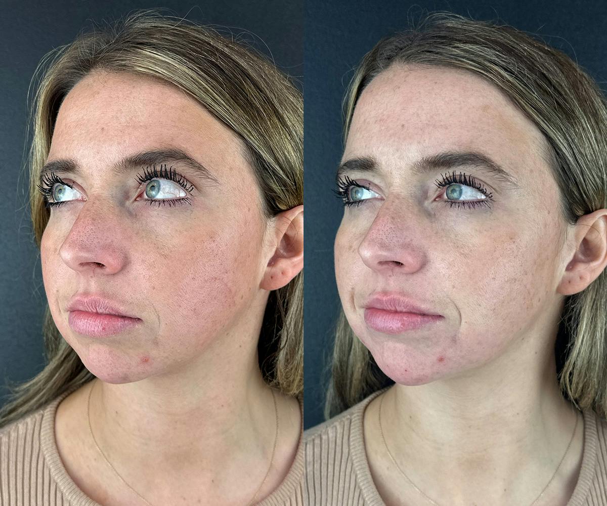 Chin Filler Before & After Gallery - Patient 209240 - Image 2