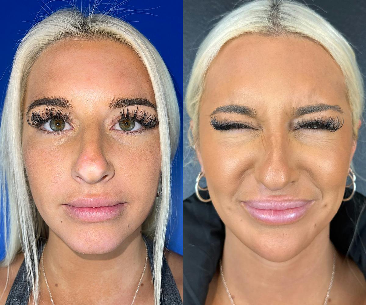 Chin Filler Before & After Gallery - Patient 111494 - Image 1