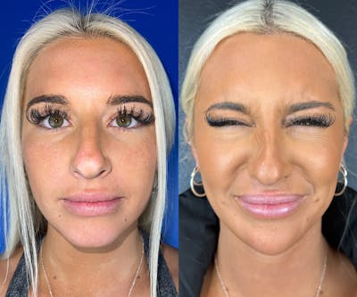 Chin Filler Before & After Gallery - Patient 111494 - Image 1