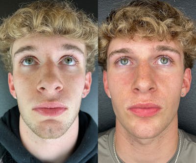 Chin Filler Before & After Gallery - Patient 496980 - Image 1