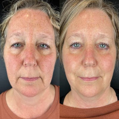 Laser Resurfacing Before & After Gallery - Patient 231024 - Image 1