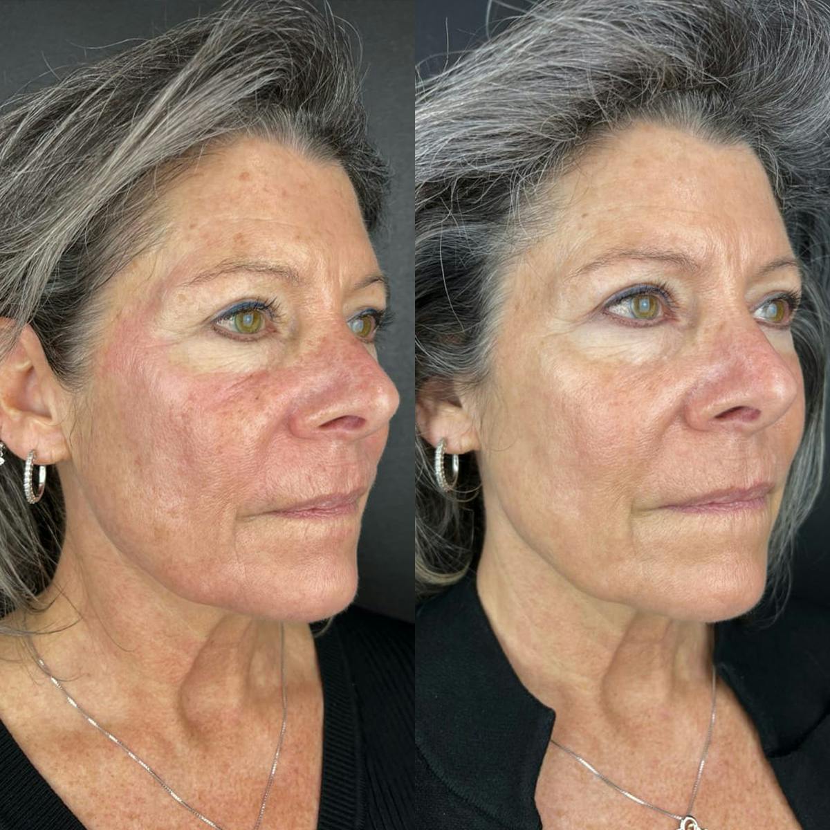 Laser Resurfacing Before & After Gallery - Patient 232036 - Image 1