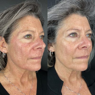 Laser Resurfacing Before & After Gallery - Patient 232036 - Image 1